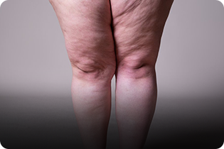Lipedema